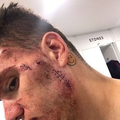 Citys Torwart Ederson übel zugerichtet