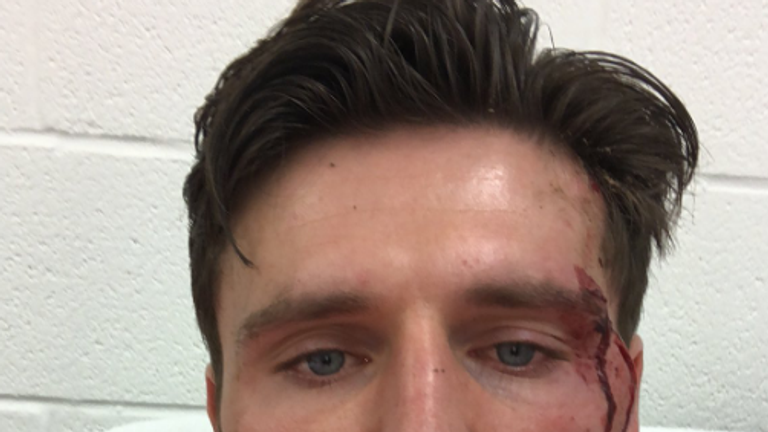 Forest-Green-Keeper James Montgomery hofft auf Spenden für neue Zähne.