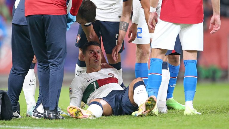 Cristiano Ronaldo lag nach einem Zusammenprall blutend am Boden.