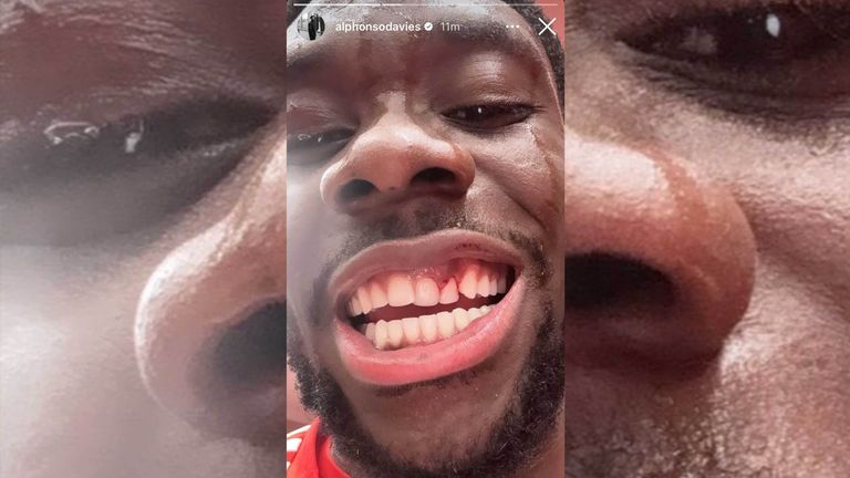 Alphonso Davies zeigt seine Verletzung nach dem 8:1-Sieg gegen Augsburg (Quelle: Instagram @alphonsodavies)